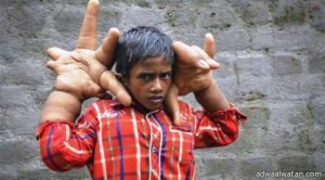 بالصور .. طفل هندي يُحيّر العلماء بأيدي عملاقة