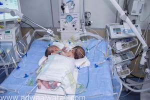 ولادة توأم سيامي يمني الجنسية بمستشفى “أبها للولادة والأطفال‎”