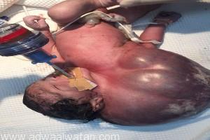 بالفيديو والصور .. ولادة أول جنين بالمملكة يحمل ورماً حميداً على رقبته يفوق وزنه بصحة جيدة بجدة