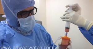 فريق طبي سعودي ينجح في إجراء ثلاث عمليات حقن الخلايا الدهنية “Lipogem”