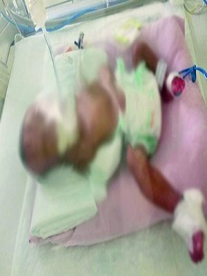 كارثة جديدة وخطأ طبي يؤدي لبتر يد طفل مولود لم يتجاوز 30 يوماً