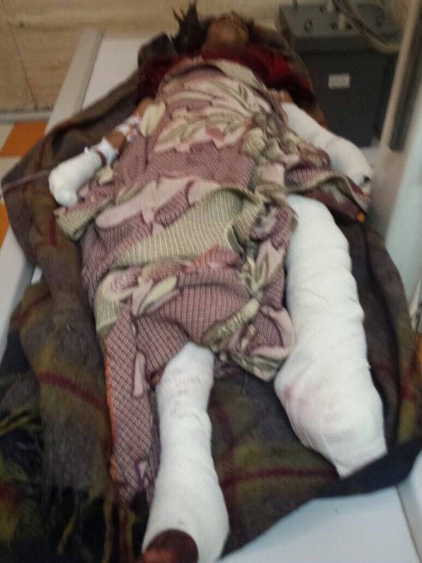 بتر ساق طفلة إثر انفجار لغم زرعته ميلشيا الحوثي في “القوز”