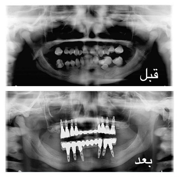 ” سعود الطبية ” تنهي معاناة شقيقتين أسنانهما تتحرك بشكل كامل بالرياض