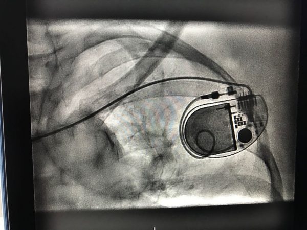 نجاح عملية تركيب منظم لنبضات القلب لسبعينية في “سعود الطبية”