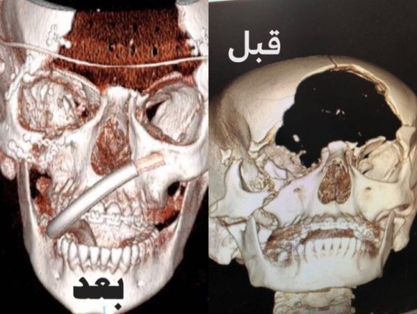 عملية جراحية بـ”سعود الطبية” تلفت أنظار وزير الصحة