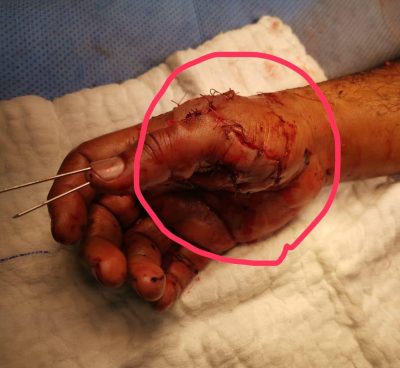 إعادة أصبع مريض باستخدام المجهر الجراحي بـ سعود الطبية