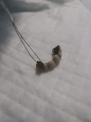 استخراج طقم أسنان من بطن ستيني ابتلعه بالخطأ في مستشفى الملك فهد