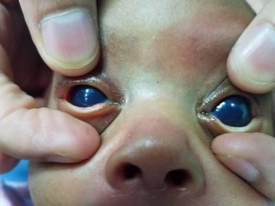 عملية جراحية ناجحة لإزالة مياه زرقاء من عين طفل ببيشة