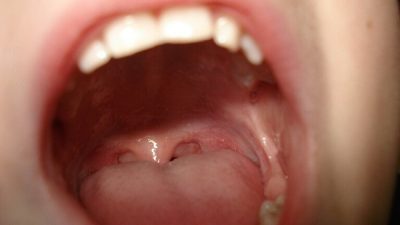 اكتشاف عارض جديد لـ”كوفيد-19″ يظهر في الفم قبل الأعراض الرئيسية للمرض