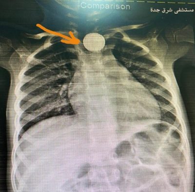 عملية دقيقة تنجح في إنقاذ طفلة بعمر ثلاث سنوات بمستشفى شرق جدة