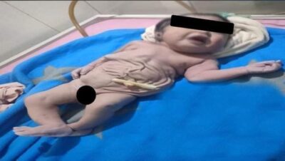 حالة نادرة.. وفاة طفل بعد ولادته دون بطن جنوب مصر