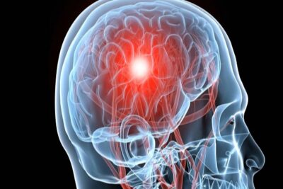 التهاب الدماغ.. الأسباب وطرق العلاج