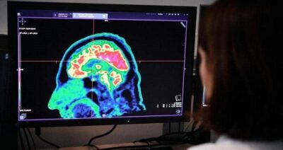 علماء يكتشفون مسار تفشي الزهايمر في الدماغ