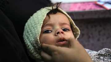 ظهور حالات شلل أطفال باليمن.. ووزير يمني يتهم الحوثي بعدم التعاون