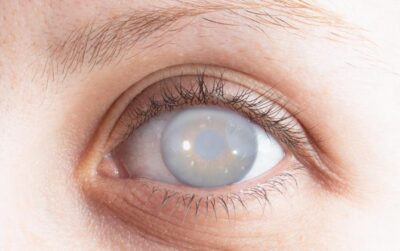 “سعود الطبية” توضح أبرز أعراض إصابة العيون بالماء الأبيض.. وطرق علاجه
