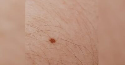 سرطان الجلد.. “هذه العلامة” دليلك للكشف المبكر