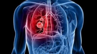 “قاتل خفي” يسبب سرطانات الرئة لغير المدخنين.. دراسة تكشف