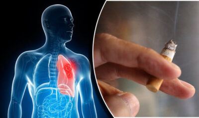 استشاري قسطرة شرايين يحذر من استمرار التدخين بعد الإصابة بجلطة في القلب