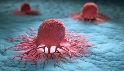 علماء يطرحون اختبارا طبيا يكشف سرطان البروستاتا بشكل مبكر