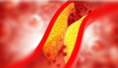 لمرضى الكوليسترول.. استشاري قلب يُحذر من خطأ شائع يؤدي لحدوث جلطات