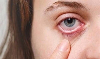الكشف عن علامة تحذيرية في العين تشير إلى الإصابة بالسكتة الدماغية