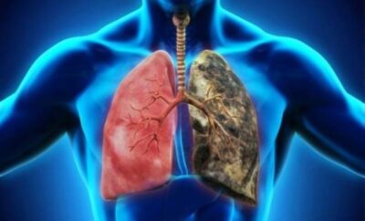 سانوفي: عقارنا لعلاج «رئة المدخن» ناجع