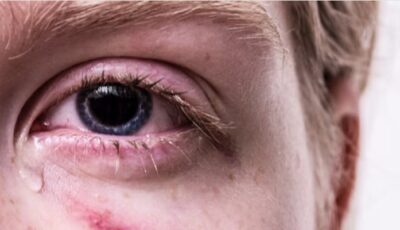 “سعود الطبية” تُوَضح أعراض وأسباب حساسية العين في فصلي الربيع والصيف