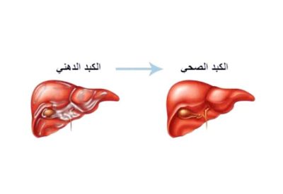 أمريكا توافق على أول دواء لعلاج «الكبد الدهني»