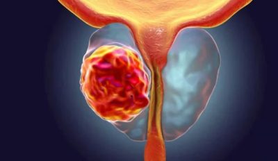 تحذير للرجال.. “زيادة معدلات الإصابة بسرطان البروستاتا” في تحذير بحثي