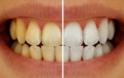 4 خطوات مهمة قبل تبييض الأسنان