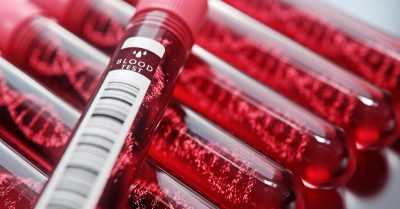 أمراض الدم الوراثية.. “صحة الرياض” توصي باتخاذ سبل الوقاية من المضاعفات