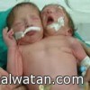 ولادة نادرة لـ”امرأة مصرية” وضعت طفلاً برأسين وقلبين وثلاث أذرع